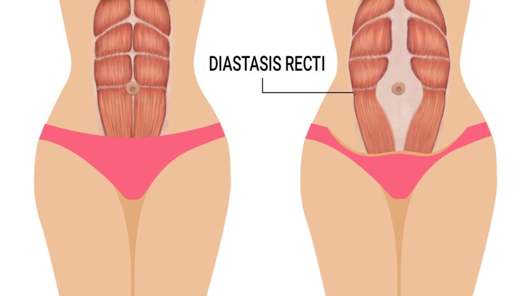 Diastasis Rectii