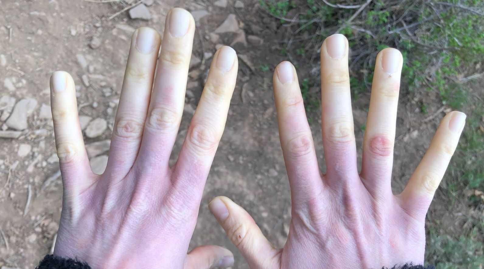 Hands with white fingers during a Raynaud's Syndrome episode