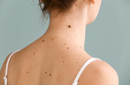 Woman's skin with moles