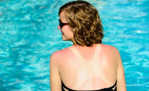Woman by pool with exposed skin showing suntan, sunburn, and swimsuit lines